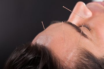 דיקור סיני וכאבי ראש